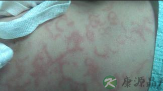 荨麻疹患者如何治疗? 荨麻疹患者如何治疗?