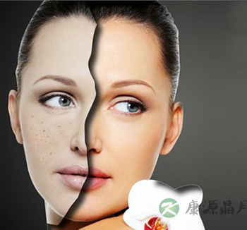 什么是激光祛斑 激光祛斑有副作用吗