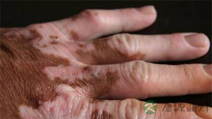 民间流传的白癜风偏方