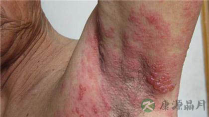 民间治疗蛇胆疮偏方