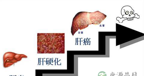 民间肝硬化的实用偏方
