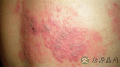 民间治疗蛇胆疮偏方