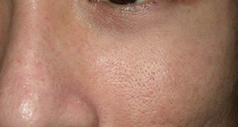 如何对付粗大毛孔