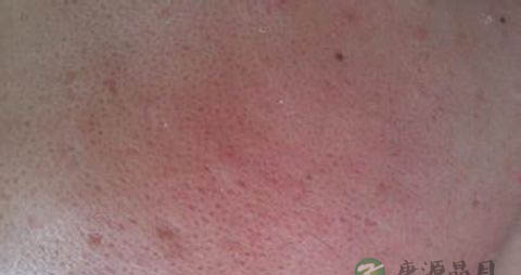 怎么样改善毛孔粗大