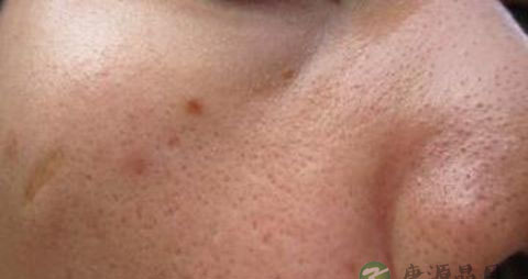 怎么样改善毛孔粗大