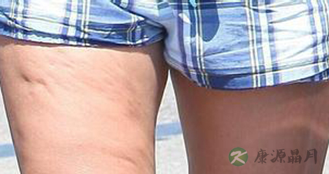 【如何消除橘皮纹】消除橘皮纹有方法