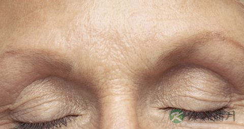 【怎样祛除皱纹】如何祛除皱纹