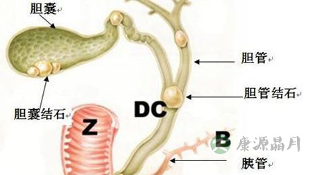 胆囊息肉