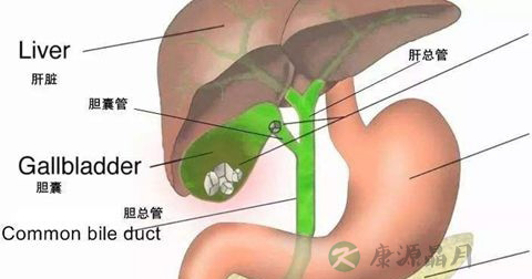 胆囊结石