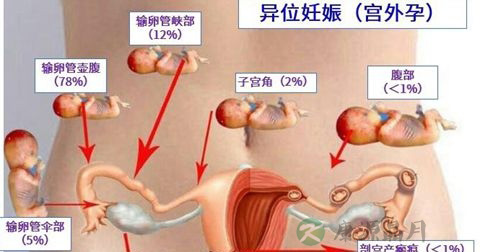 宫外孕大出血