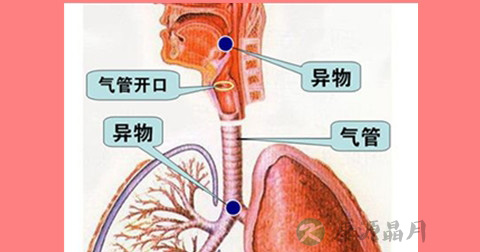 咽部异物