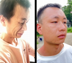 面部抽搐多年，寻医多年，只有鍉针见效！！