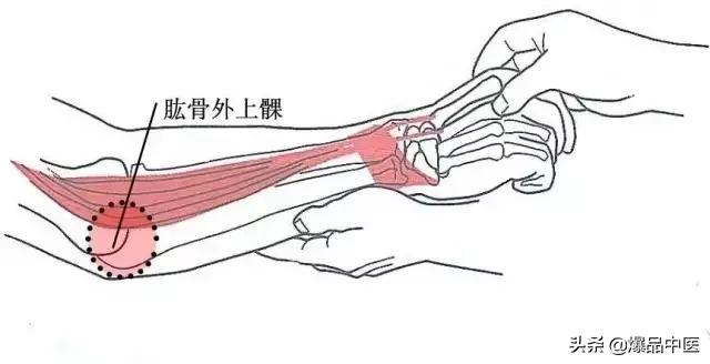 软组织常见压痛点