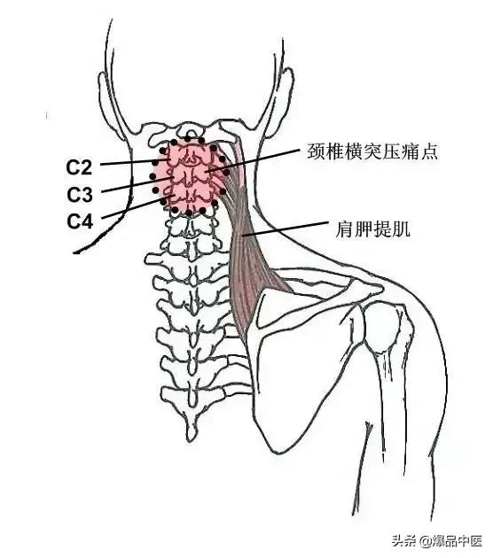 软组织常见压痛点