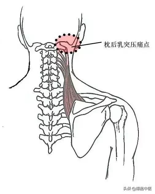 软组织常见压痛点