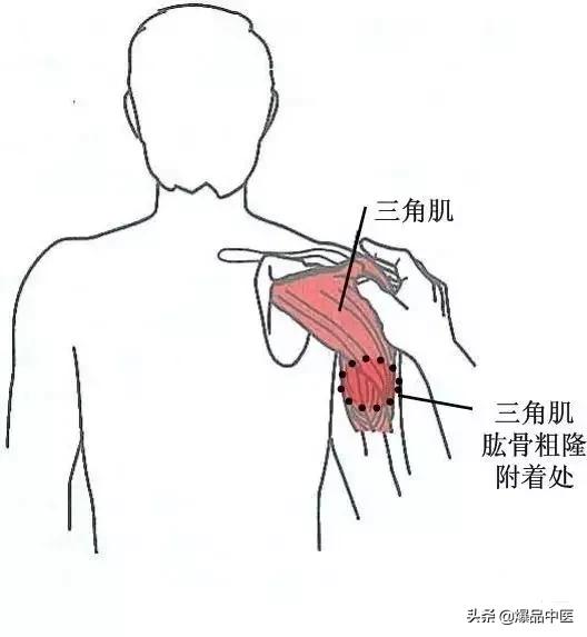 软组织常见压痛点