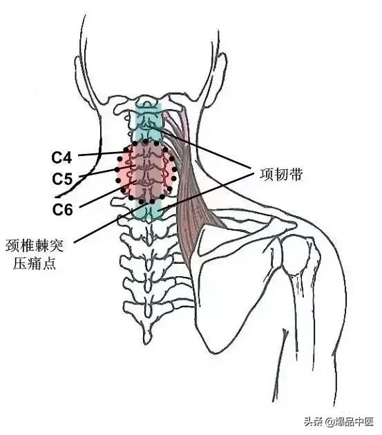 软组织常见压痛点