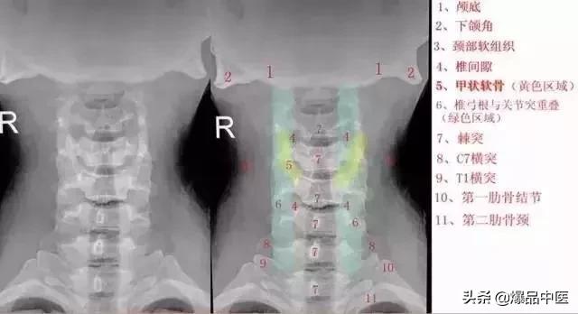 这样看颈椎X线，你也能成为高手
