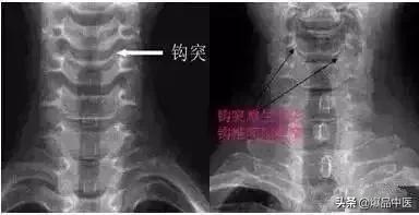 这样看颈椎X线，你也能成为高手