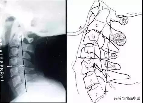 这样看颈椎X线，你也能成为高手