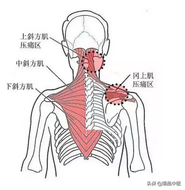 颈肩病常见的几个压痛点！治疗颈肩不适，经典好文章