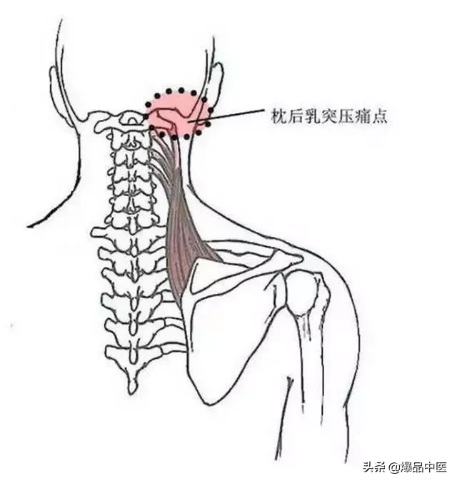 颈肩病常见的几个压痛点！治疗颈肩不适，经典好文章