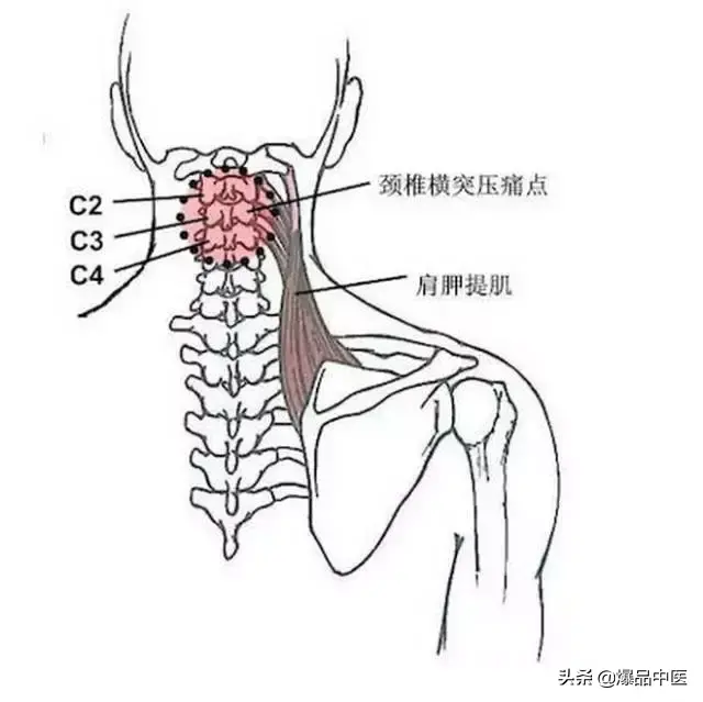 颈肩病常见的几个压痛点！治疗颈肩不适，经典好文章