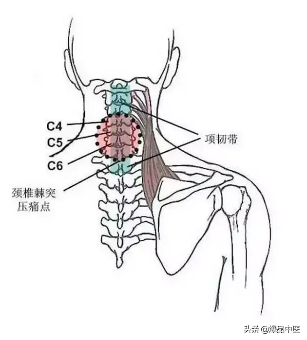 颈肩病常见的几个压痛点！治疗颈肩不适，经典好文章