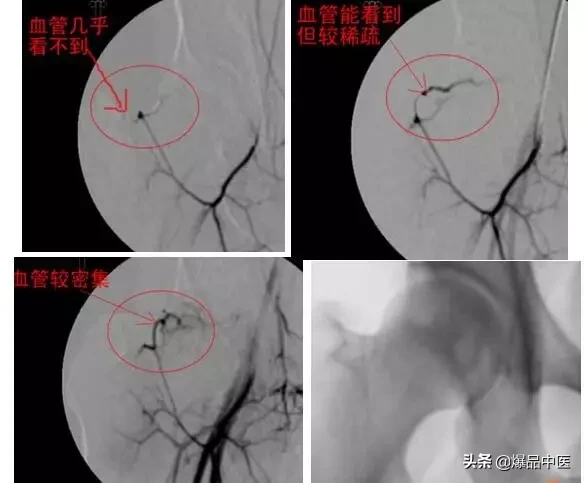 股骨头坏死的诊断与治疗策略，康源干货分享