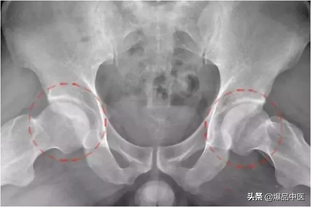 股骨头坏死的诊断与治疗策略，康源干货分享