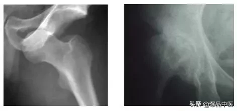 股骨头坏死的诊断与治疗策略，康源干货分享