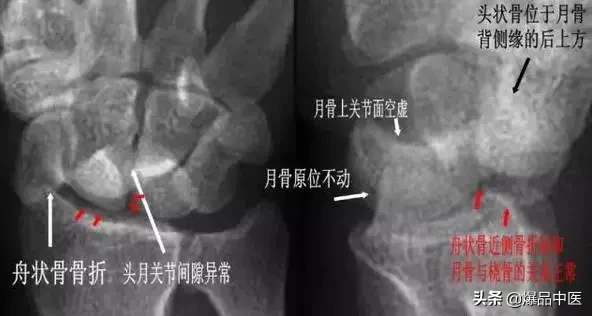 腕关节脱位及X线阅片技巧