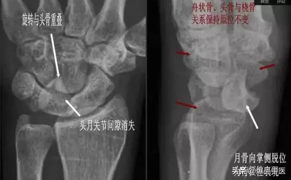 腕关节脱位及X线阅片技巧