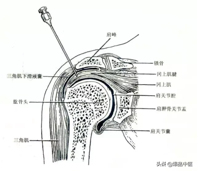 关节穿刺技巧「髋、膝、踝、肩、肘、腕」