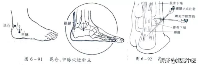 关节穿刺技巧「髋、膝、踝、肩、肘、腕」