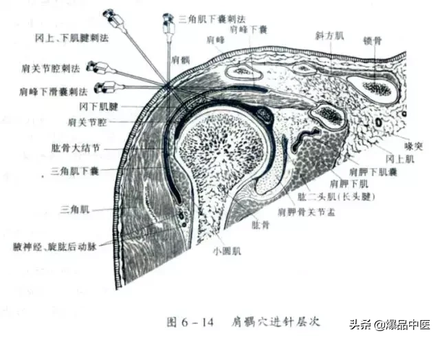 关节穿刺技巧「髋、膝、踝、肩、肘、腕」