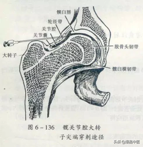 关节穿刺技巧「髋、膝、踝、肩、肘、腕」