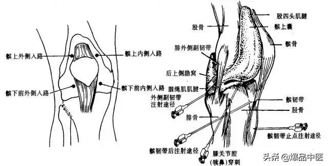 关节穿刺技巧「髋、膝、踝、肩、肘、腕」