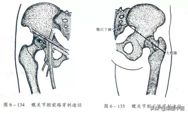 关节穿刺技巧「髋、膝、踝、肩、肘、腕」