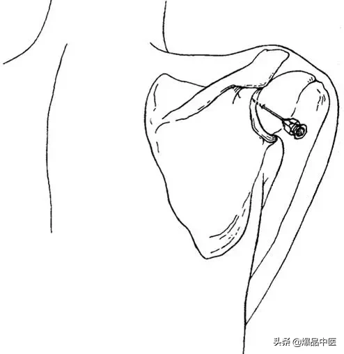 关节穿刺技巧「髋、膝、踝、肩、肘、腕」