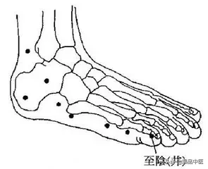 各种痛症的针灸治疗(值得收藏)