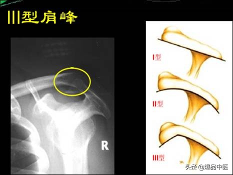 肩袖损伤的诊断和治疗