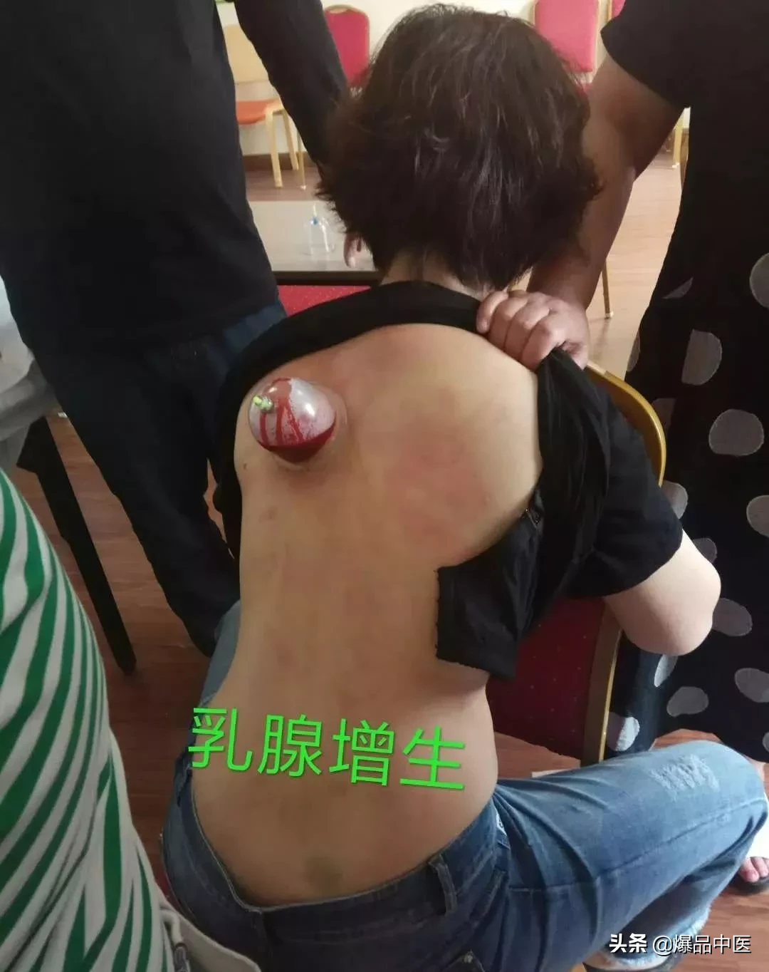 刺络放血，大病小病都不怕