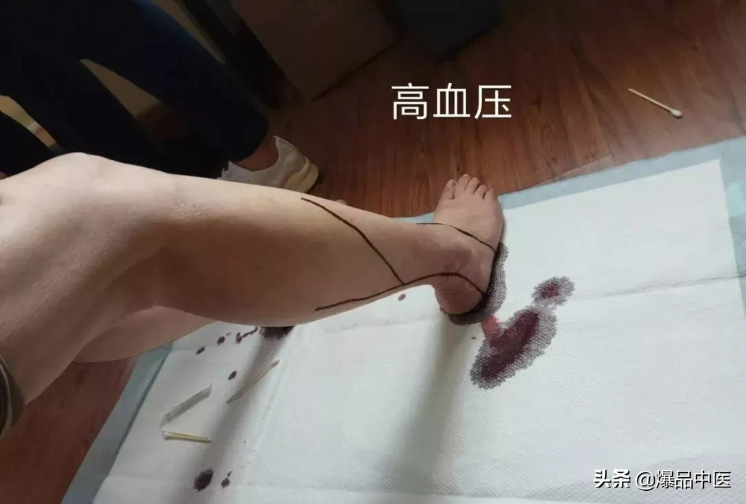 刺络放血，大病小病都不怕