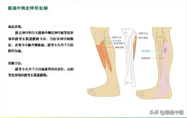 针刀治疗图解