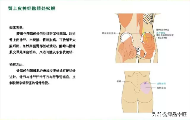 针刀治疗图解