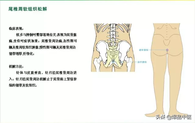 针刀治疗图解