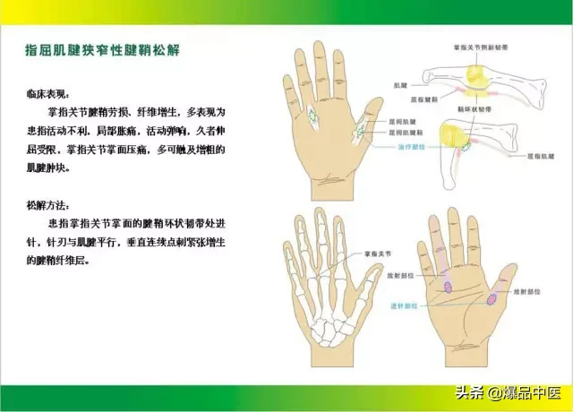 针刀治疗图解