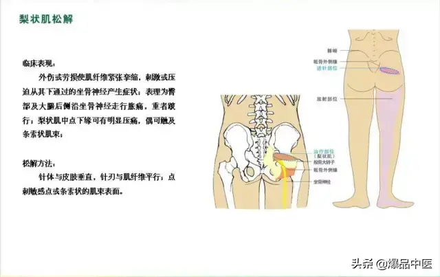 针刀治疗图解