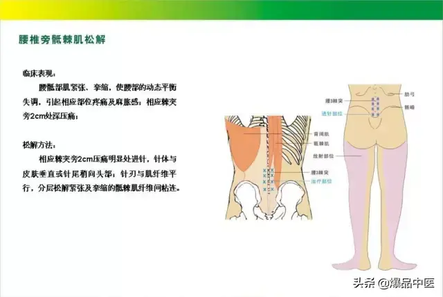 针刀治疗图解